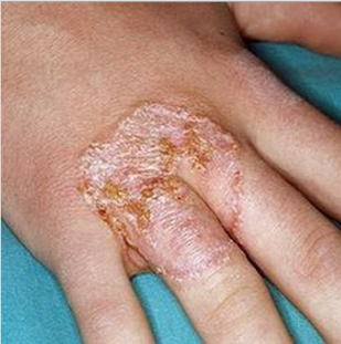 How to cure ringworm naturally
