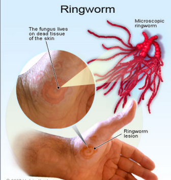 How to cure ringworm on skin